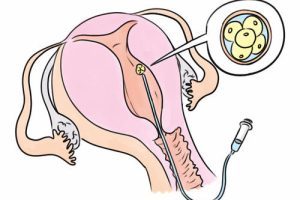 多囊卵巢综合征伴随胰岛素抵抗:为何会影响生育?