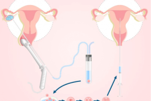 辅助生殖技术费用全解析：从组成到影响因素