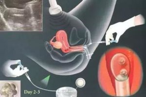 第三代试管婴儿：给宝宝的基因“安全盾”，私立医院该怎么选？