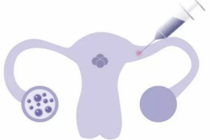 试管婴儿短方案：启动时间不用死磕“月经第2天”，跟着卵巢节奏走才对