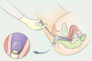 高质量胚胎培养：不是100%成功，但为什么医生还推荐？