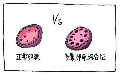 多囊卵巢试管婴儿,试管婴儿成功率