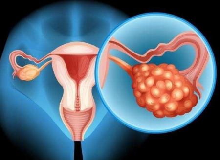 多囊患者如何提高试管成功率