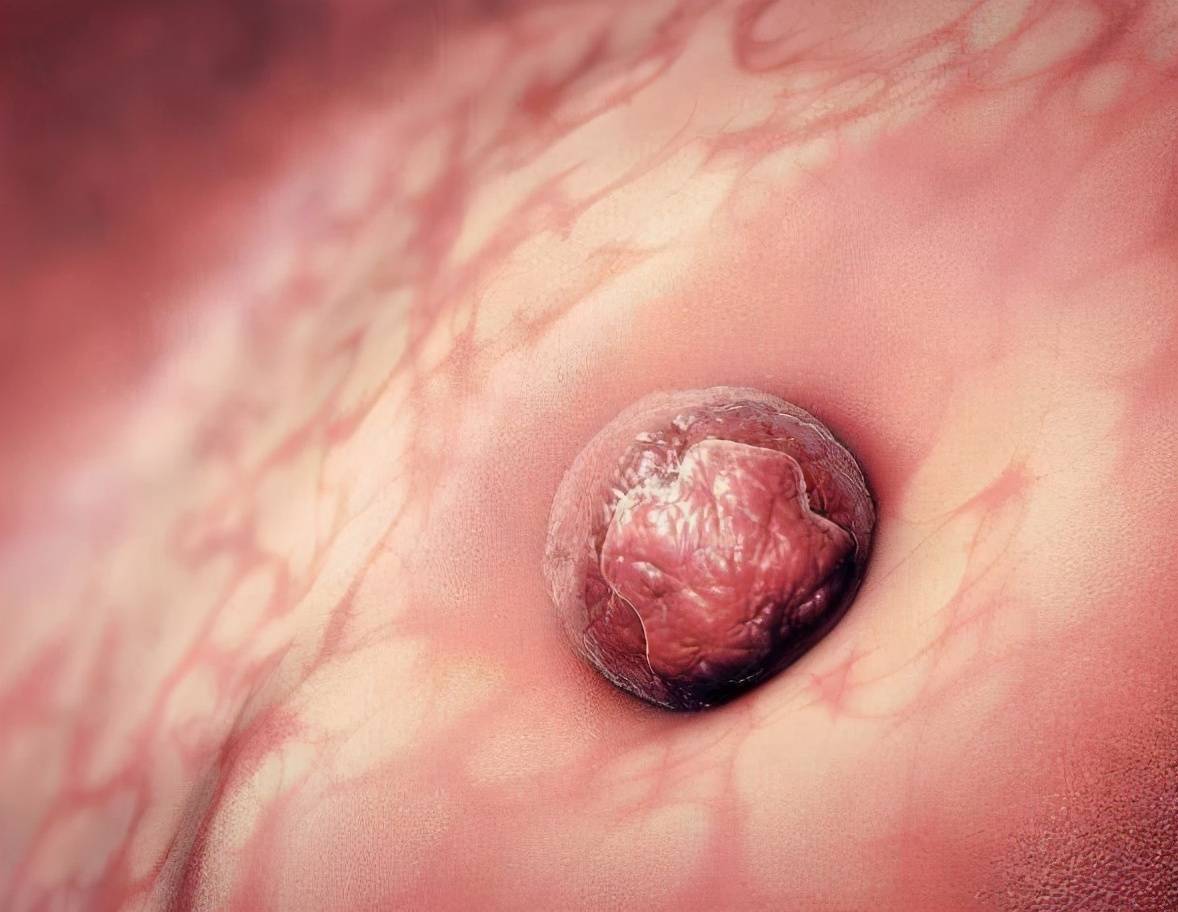 高龄试管婴儿,遗传疾病,羊水穿刺技术