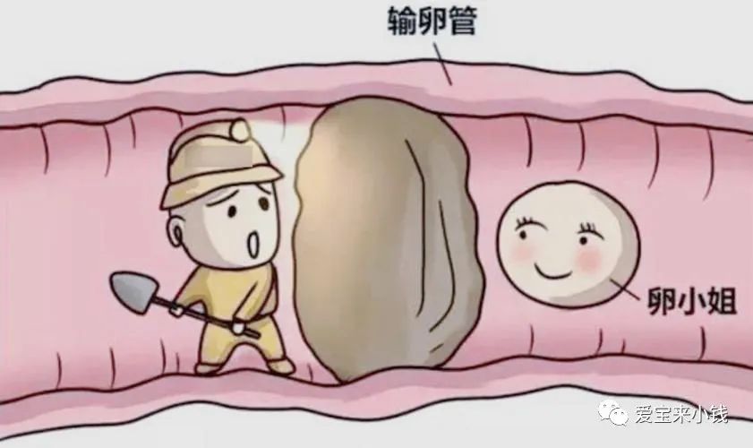 试管婴儿,输卵管堵塞,不孕