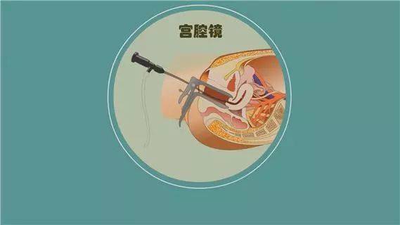 试管婴儿,宫腔镜检查