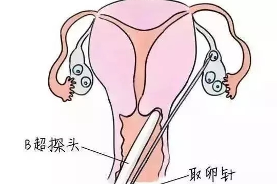 做试管婴儿疼吗