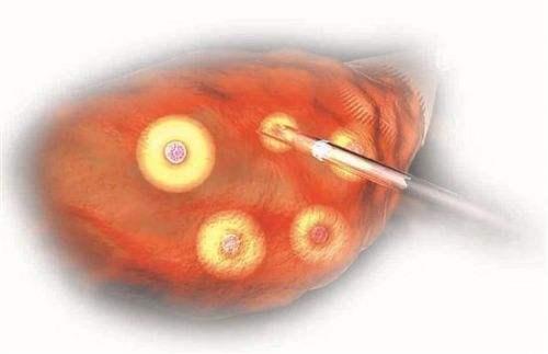 昆明试管医院,试管婴儿