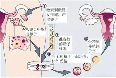试管婴儿的具体步骤