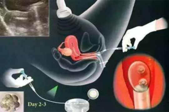 泰国试管婴儿取卵后多久可以移植,泰国试管婴儿取卵,泰国试管婴儿移植