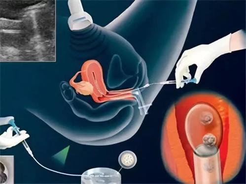 泰国试管婴儿取卵过程要多久,试管婴儿取卵过程要多久