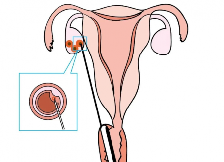 试管婴儿取卵怎么做的全过程详解