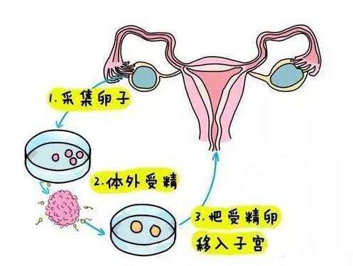 第三代试管婴儿胚胎移植