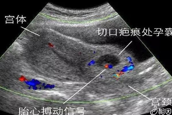 45岁生三胎有危害